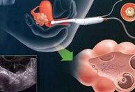 沈阳做第三代试管婴儿多少钱？